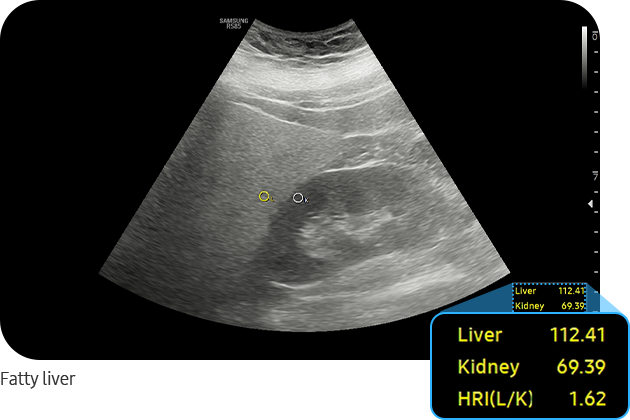 Fatty liver