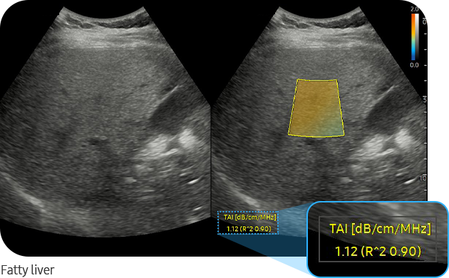 Fatty liver