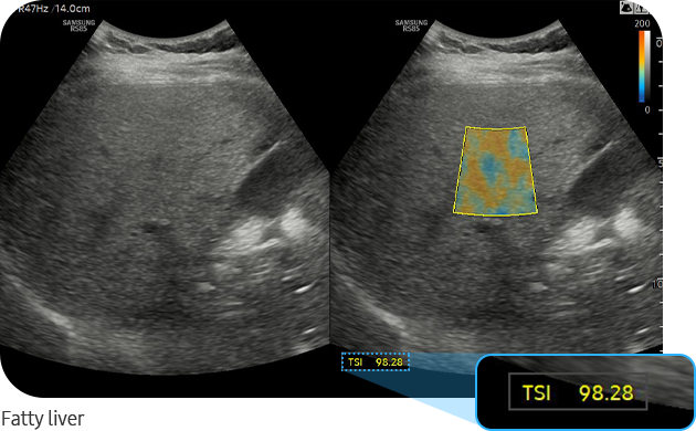 Fatty liver