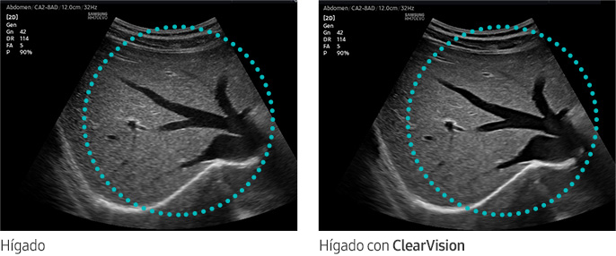 Hígado, Hígado con ClearVision