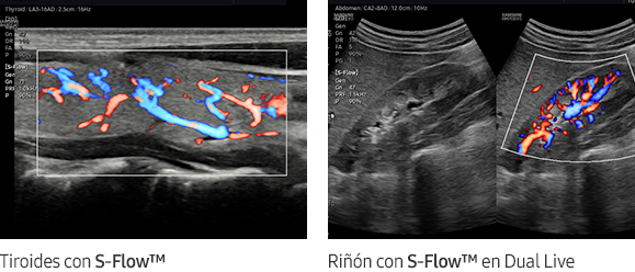 Tiroides con S-Flow™, Riñón con S-Flow™ en Dual Live