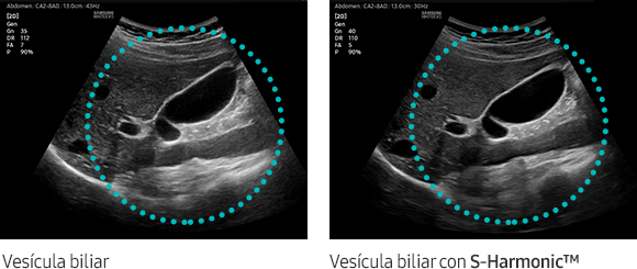 Vesícula biliar, Vesícula biliar con S-Harmonic™