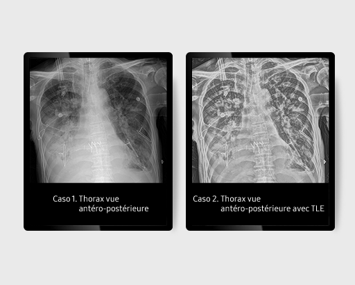 GM85-radiographie-benefices-TLE