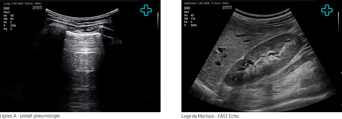 Lignes A - preset pneumologie, Loge de Morison - FAST Echo