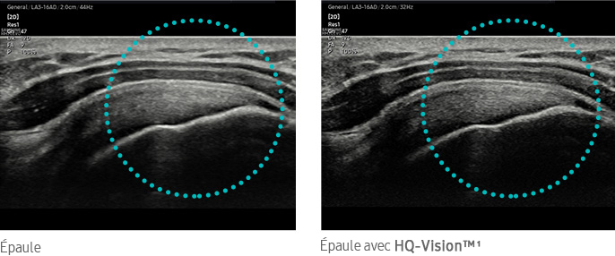 Épaule, Épaule avec HQ-Vision™
