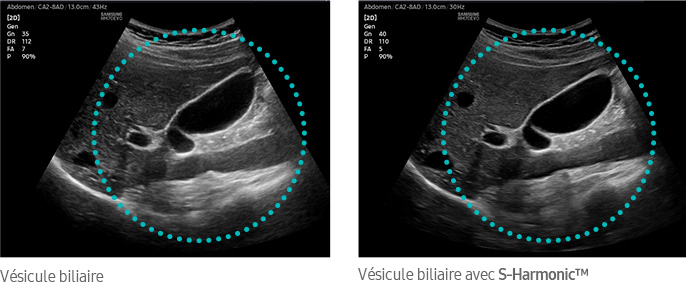 Vésicule biliaire, Vésicule biliaire avec S-Harmonic™