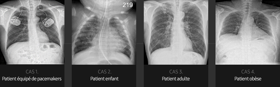 S-Vue-radiographie-benefices-qualite-image-thorax