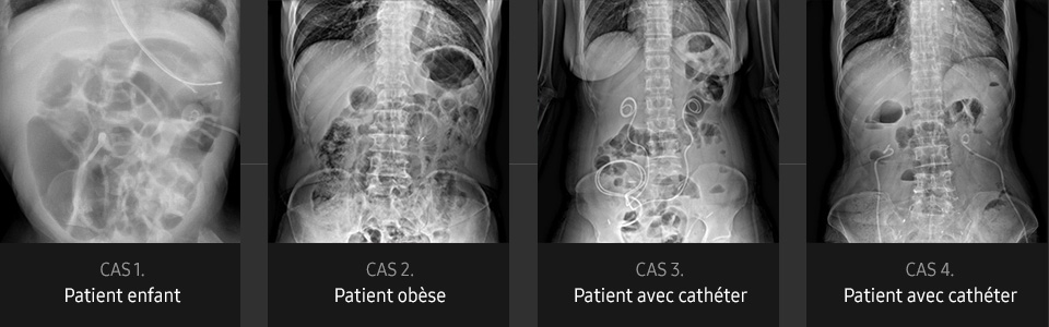 S-Vue-radiographie-benefices-qualite-image-abdomen