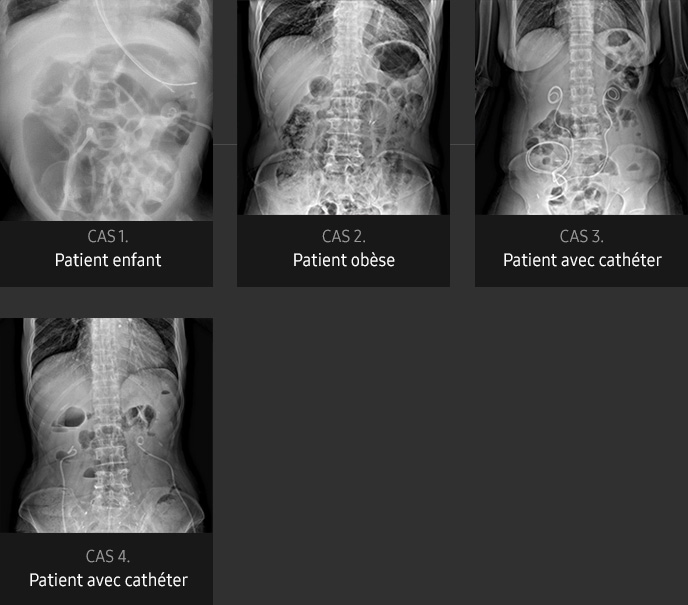 S-Vue-radiographie-benefices-qualite-image-abdomen