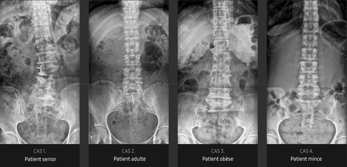 S-Vue-radiographie-benefices-qualite-image-rachis-lombaire