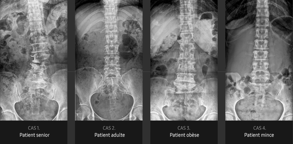 S-Vue-radiographie-benefices-qualite-image-rachis-lombaire