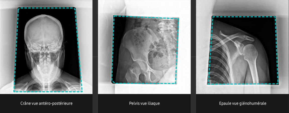 S-Vue-radiographie-benefices-qualite-image-diaphragme-automatique