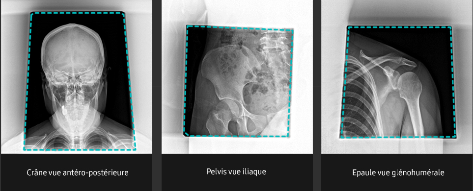 S-Vue-radiographie-benefices-qualite-image-diaphragme-automatique