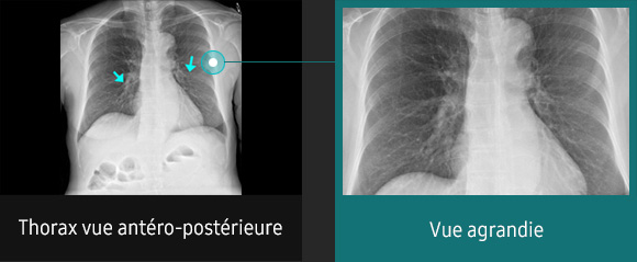 S-Vue-radiographie-benefices-amelioration-clarte-nettete-thorax