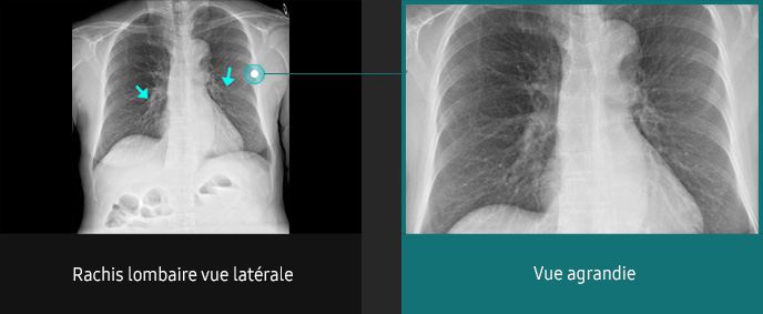 S-Vue-radiographie-benefices-amelioration-clarte-nettete-thorax