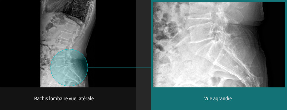 S-Vue-radiographie-benefices-amelioration-clarte-nettete-rachis-lombaire