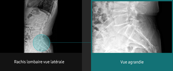 S-Vue-radiographie-benefices-amelioration-clarte-nettete-rachis-lombaire