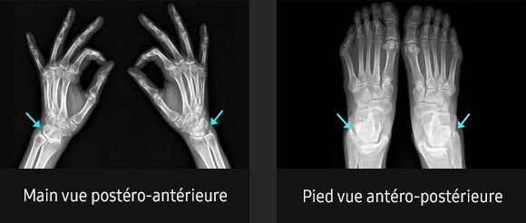 S-Vue-radiographie-benefices-amelioration-clarté-netteté-zone-superposee