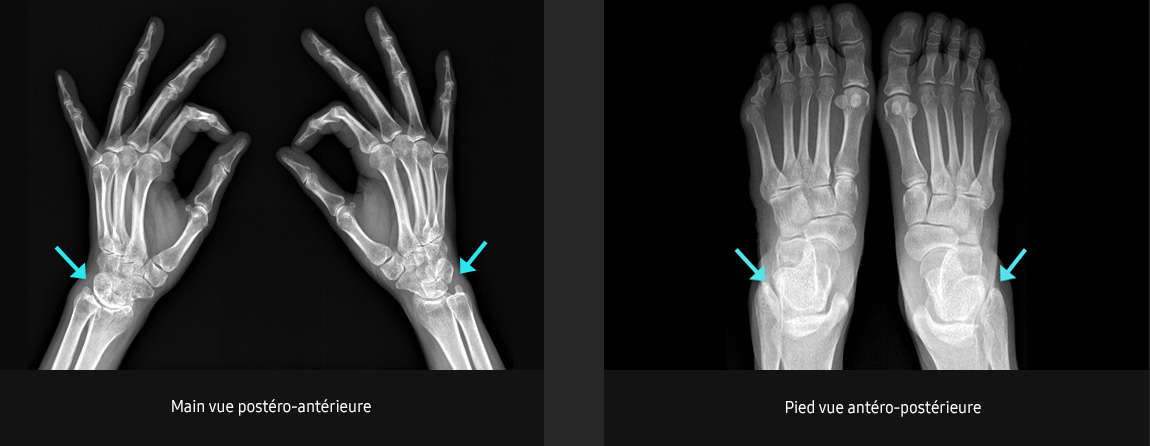 S-Vue-radiographie-benefices-amelioration-clarté-netteté-zone-superposee