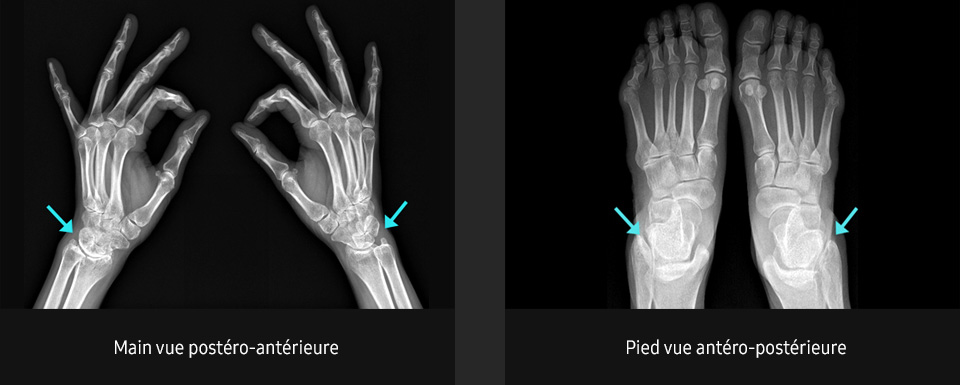 S-Vue-radiographie-benefices-amelioration-clarté-netteté-zone-superposee