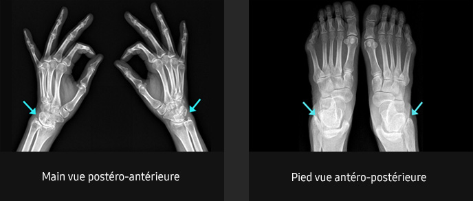 S-Vue-radiographie-benefices-amelioration-clarté-netteté-zone-superposee