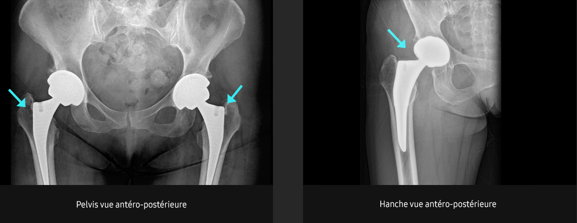 S-Vue-radiographie-benefices-amelioration-clarte-nettete-pelvis