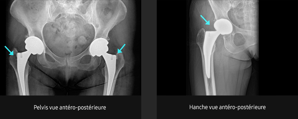 S-Vue-radiographie-benefices-amelioration-clarte-nettete-pelvis