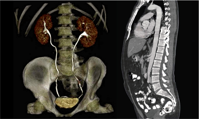 Anatomia delle vie urinarie e dei reni del paziente
