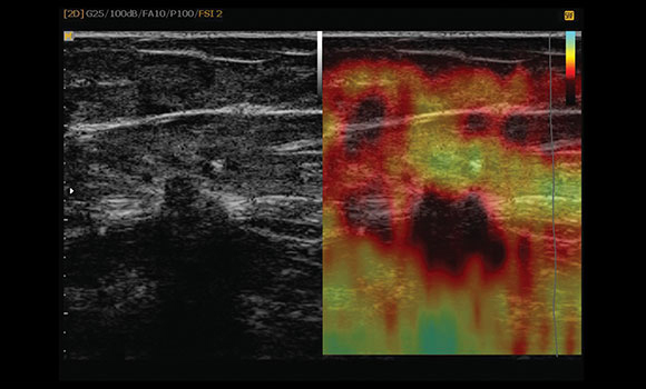 ElastoScan™ Sample