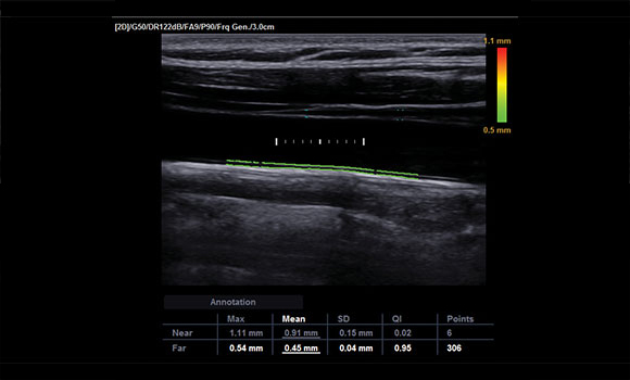 Auto IMT™ Sample