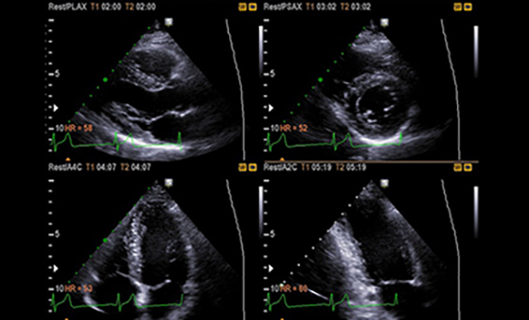 Stress Echo Sample