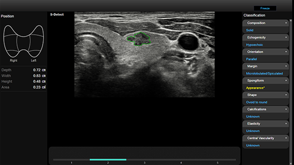 Valutazioni quantitative ottenute con software S-detect for Thyroid