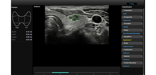 Valutazioni quantitative ottenute con software S-detect for Thyroid