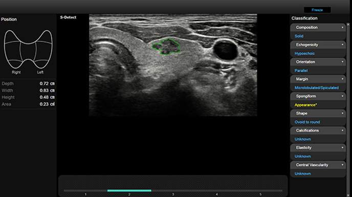 Valutazioni quantitative ottenute con software S-detect for Thyroid