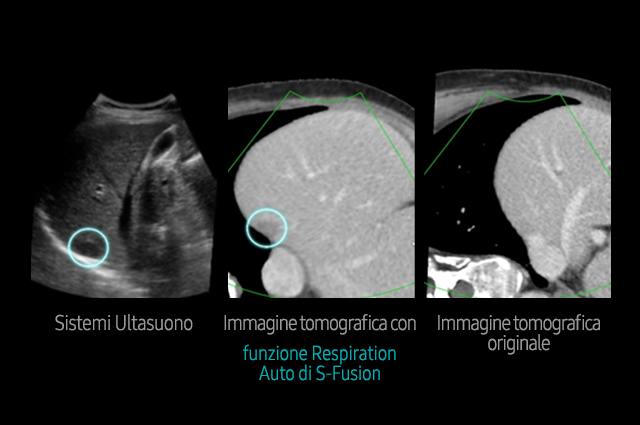 S-Detect™ for Thyroid