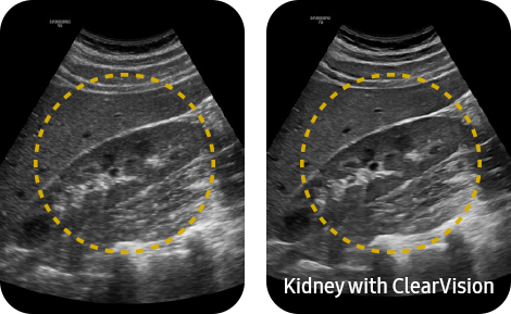 Kidney with ClearVision