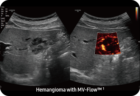 Hemangioma with MV-Flow™ ¹