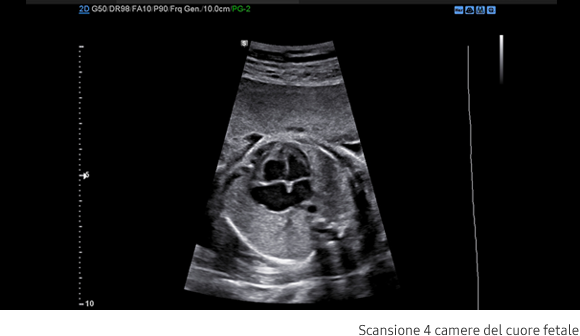Immagini cliniche delle 4 camere del cuore fetale ottenute con software S-Harmonic™