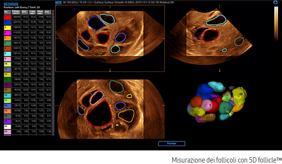 Follicle measurement with 5D follicle™