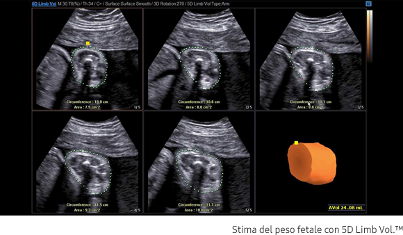 Immagine contenente una stima del peso del feto con 5D Limb Vol.™