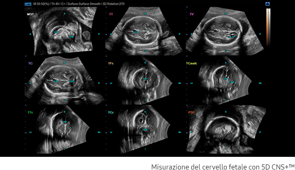 Misurazione del cervello del feto con 5D CNS+™