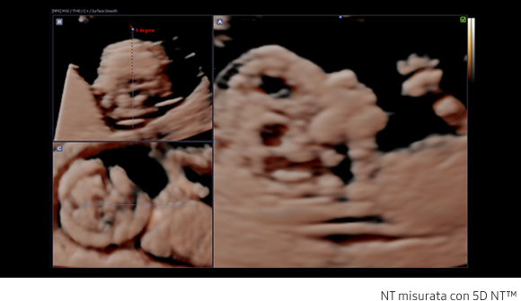 Fetal brain measurement with 5D CNS+™