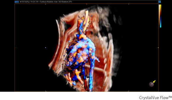 Immagine clinica della colonna vertebrale fetale ottenuta con software Crystal Vue Flow™