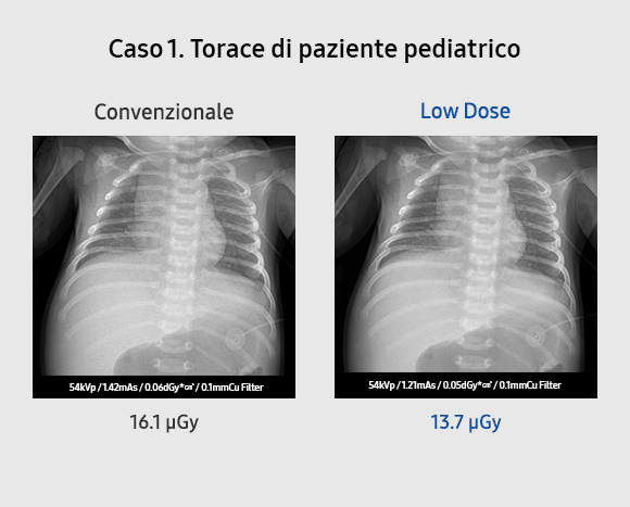 Bone Suppression