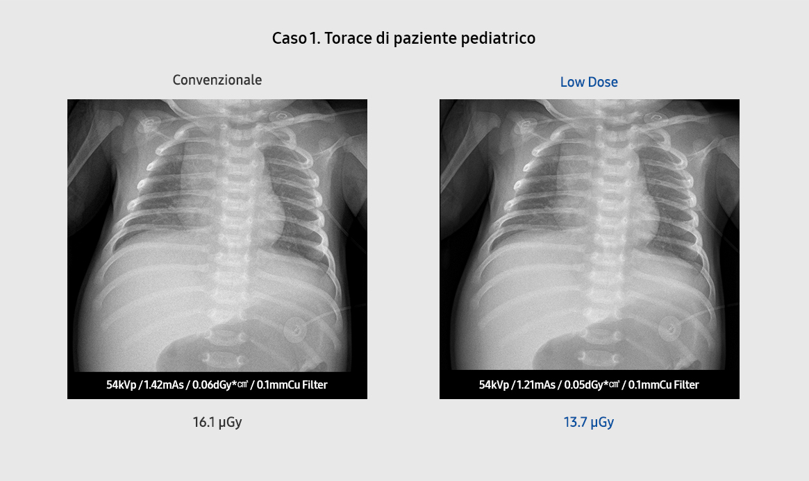 Bone Suppression