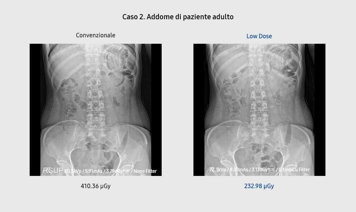 Bone Suppression