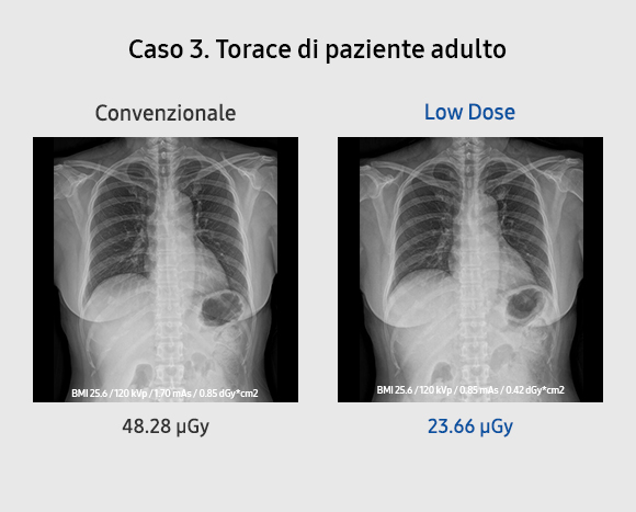 Bone Suppression