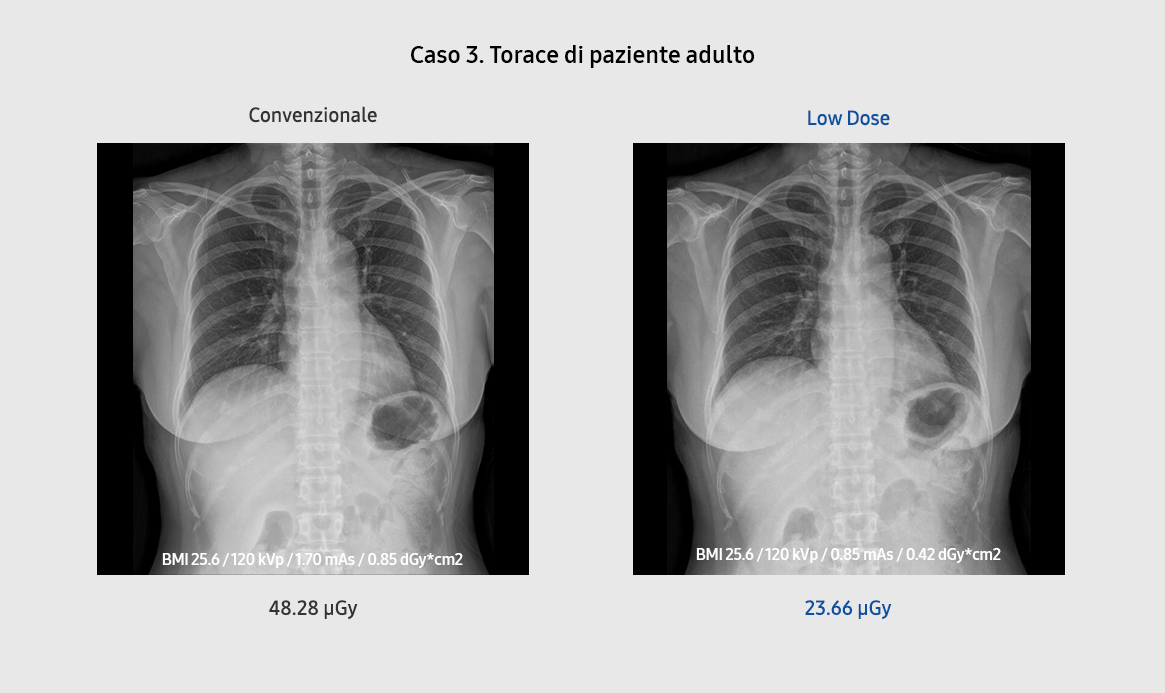 Bone Suppression