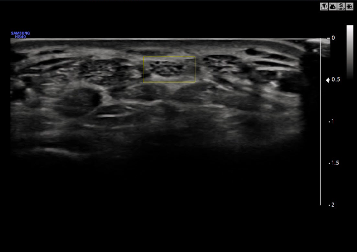 Auto IMT+™ Sample