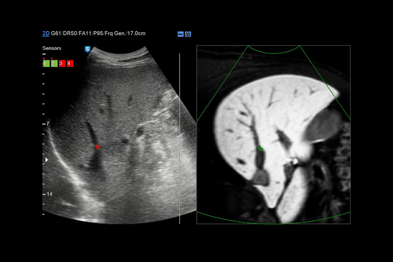 S-Detect™ for Breast